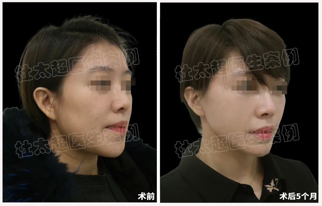 39岁女士挑战现实，拉皮手术重塑自我，重现“永不老去”的女人！