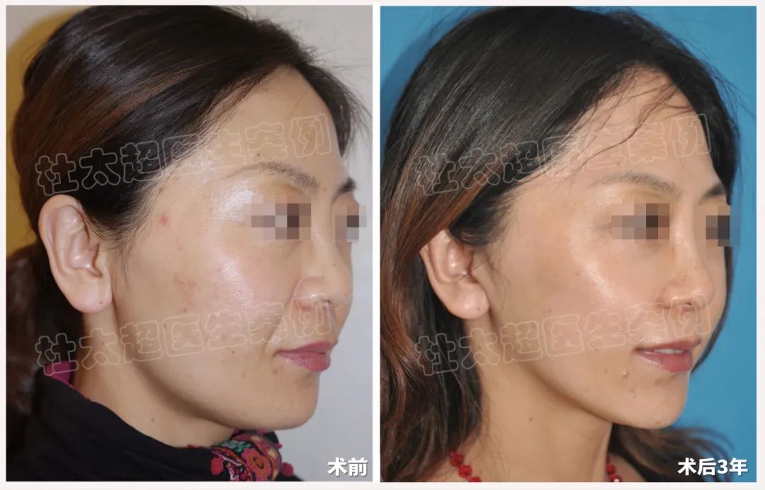 化妆品的假象还是实打实的年轻改变？——48岁求美者拉皮手术术后三年效果对比！