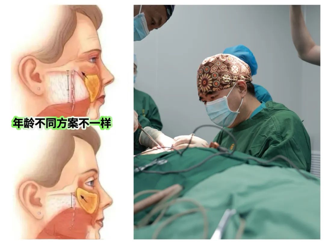 caw小切口面部提升为什么效果那么好?