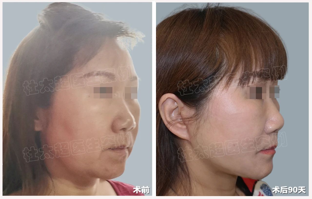 告别"馒化"大妈脸，拥抱紧致青春颜！54岁女士的惊人蜕变，您也能拥有！