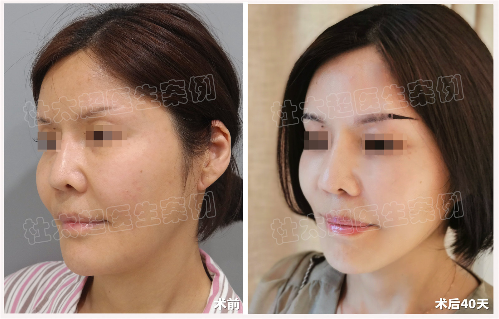 揭秘37岁女士拉皮跨越年龄鸿沟，重拾青春容颜！