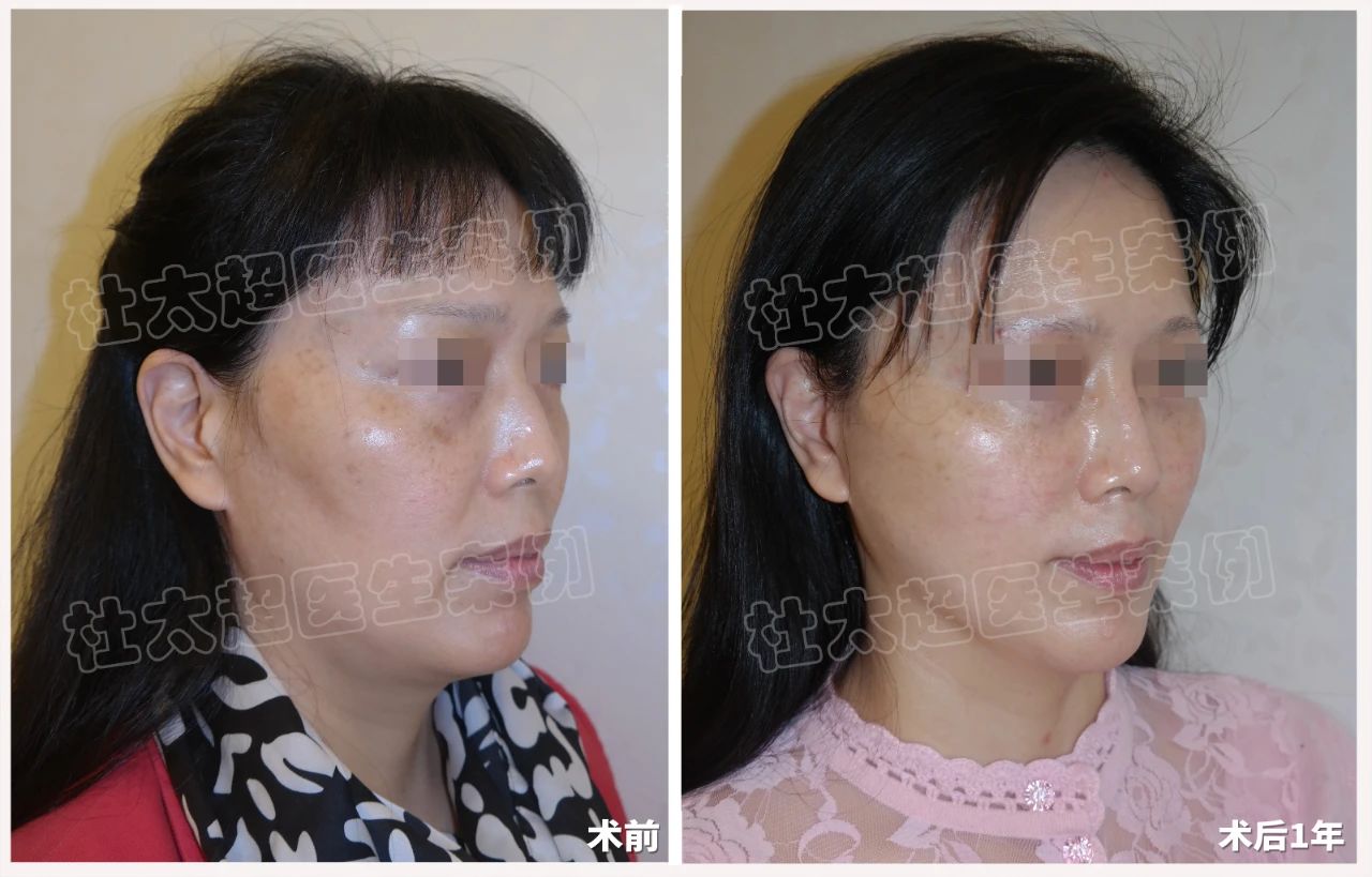 拉皮真那么可怕？56岁女士拉皮手术成功逆袭！术后一年对比