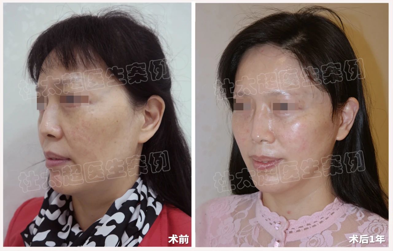 拉皮真那么可怕？56岁女士拉皮手术成功逆袭！术后一年对比