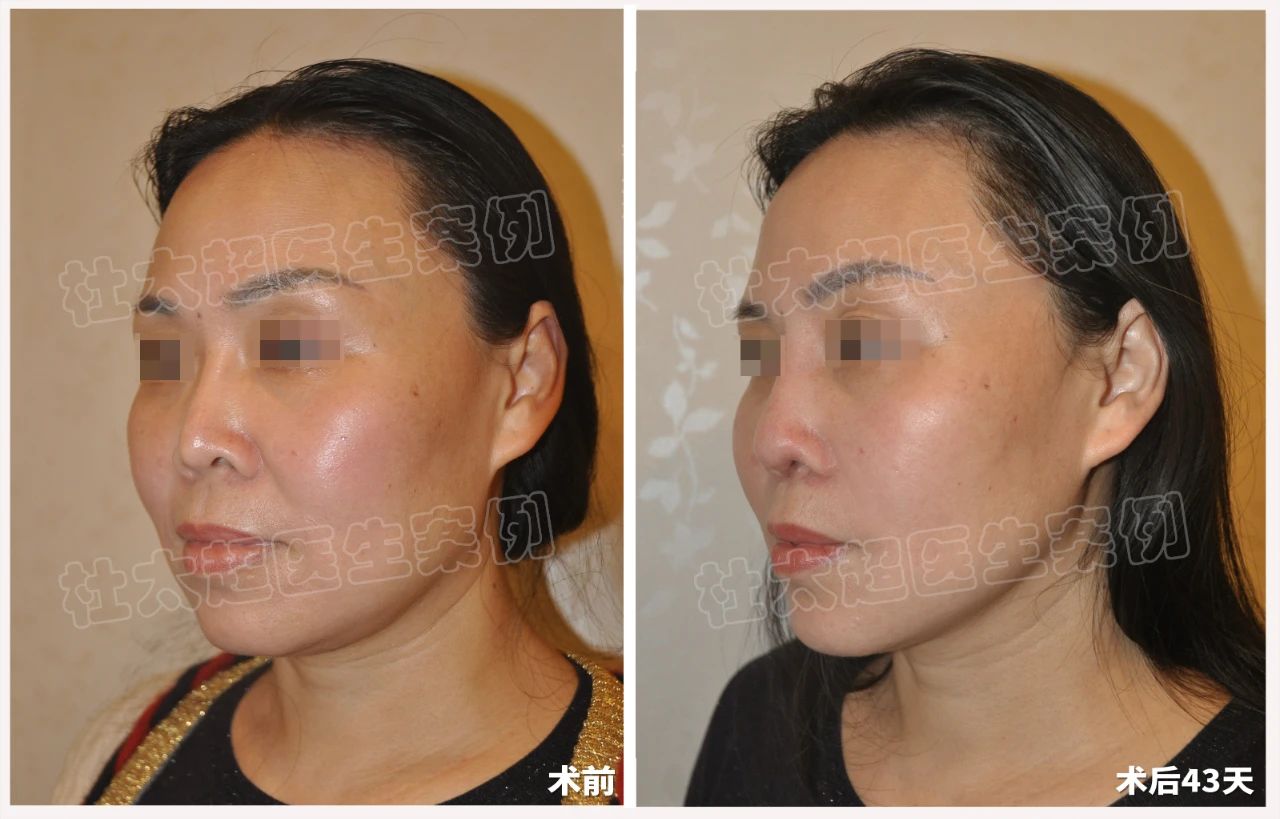 拉皮手术真的有效果吗？遇见杜太超教授，解锁50+女性逆龄新篇章！