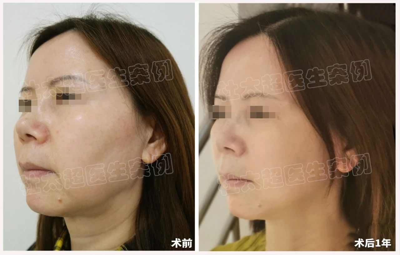 见证改变：术后一年，她如何用拉皮手术找回青春自信！