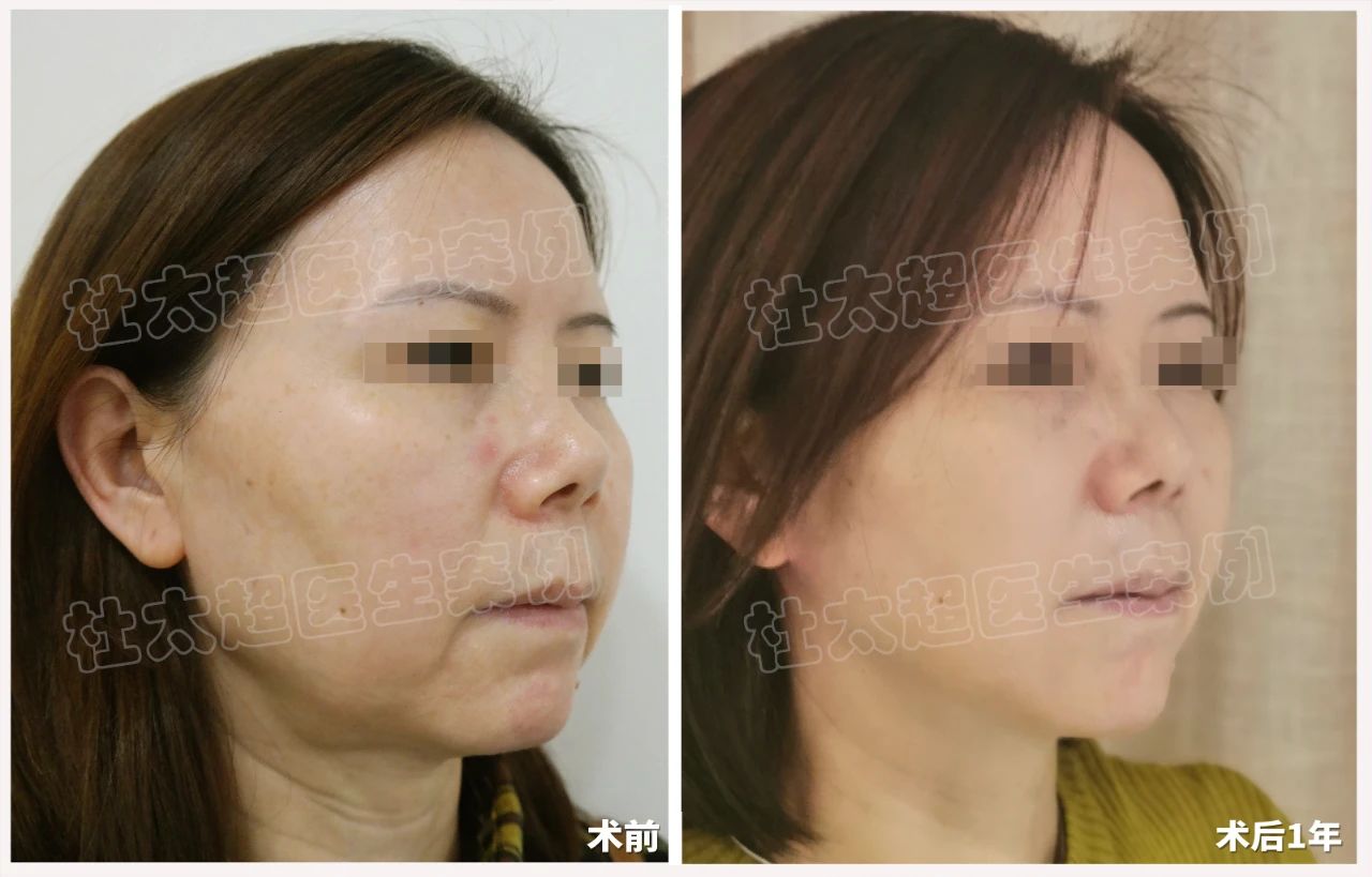 见证改变：术后一年，她如何用拉皮手术找回青春自信！