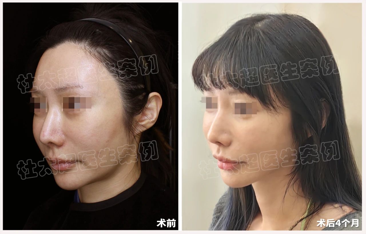 大曝光！39岁不再是年龄界限！拉皮术后4个月对比！