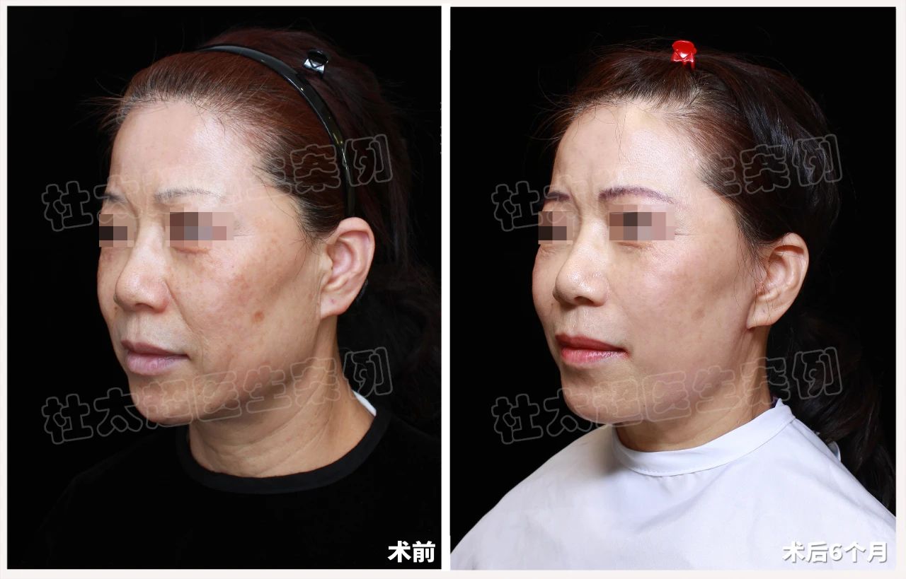 拉皮术适合我吗？看完这位55岁女士的变化再决定！