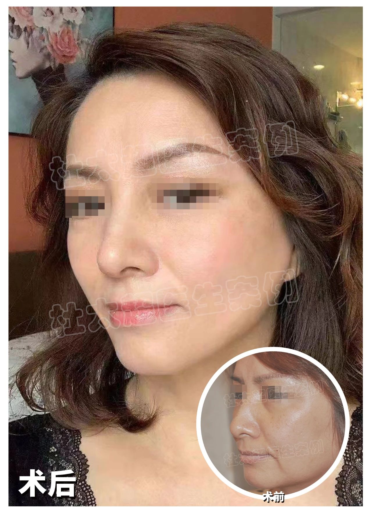 自信源于美丽,拉皮手术1年半后,见证面部逆龄奇迹! 自信源于美丽,拉皮手术1年半后,见证面部逆龄奇迹!