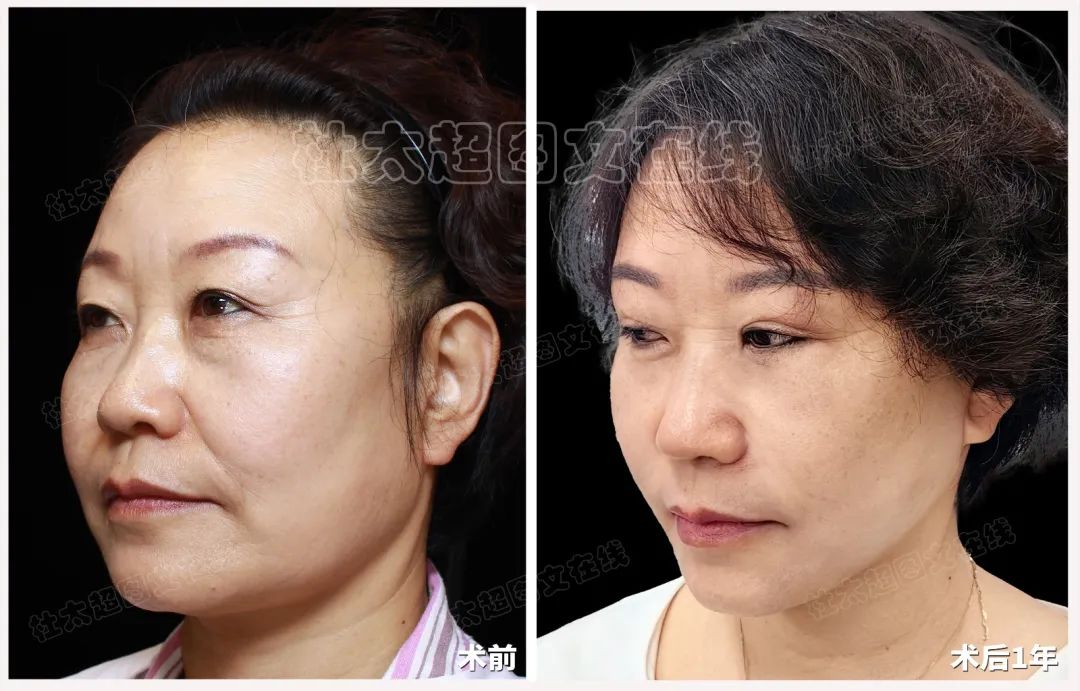 拉皮手术在一年间如何从绝望中引领她找到希望，为什么变化如此翻天覆地！