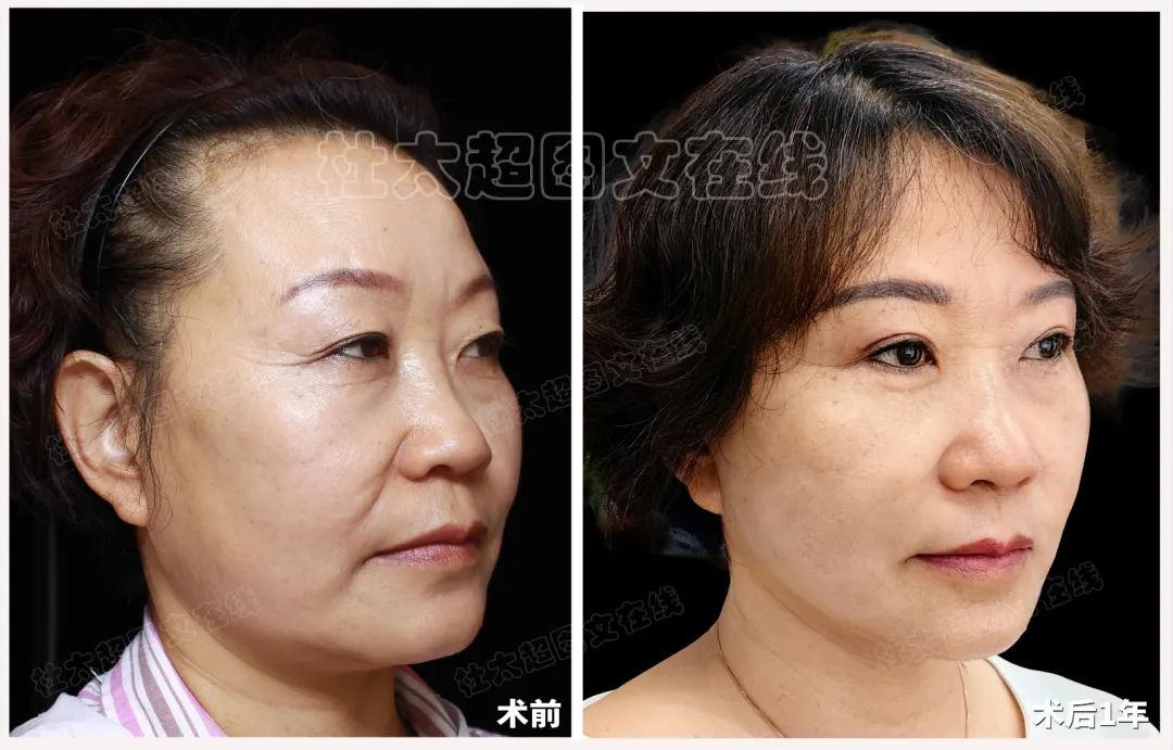 拉皮手术在一年间如何从绝望中引领她找到希望，为什么变化如此翻天覆地！