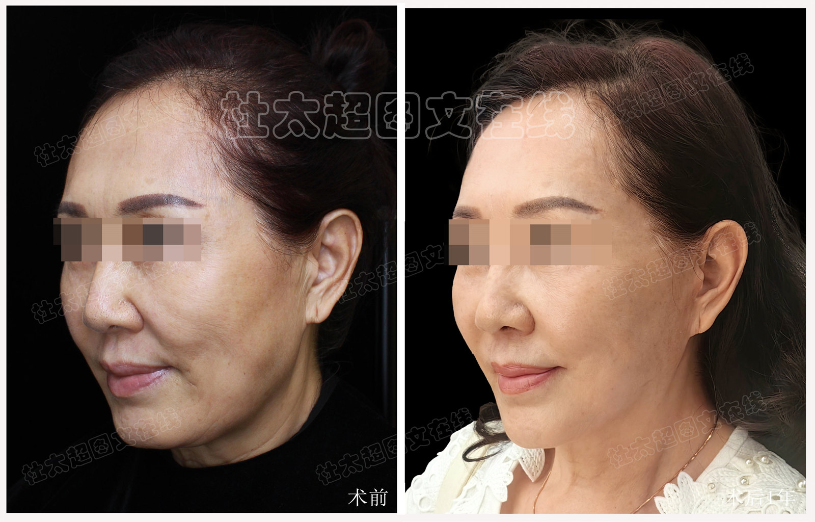 60岁不服老，飞北京做了大拉皮，没想到恢复这么自然