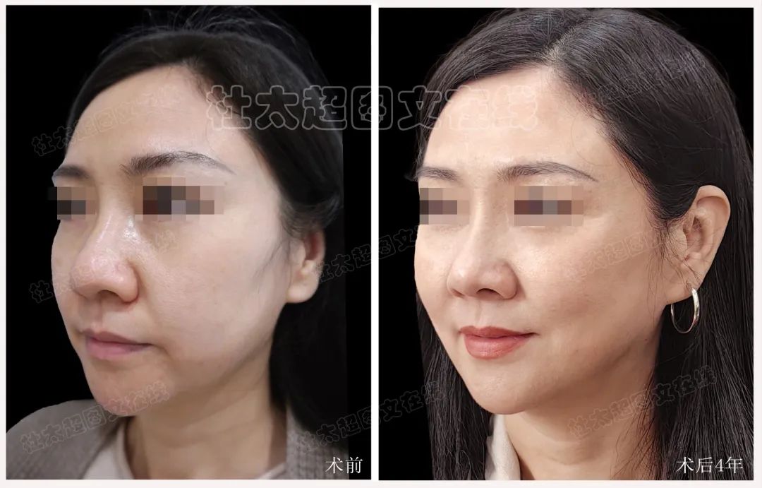 奇迹再现？拉皮手术背后的秘密，术后4年连自己都认不出了！