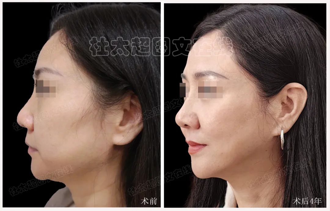 奇迹再现？拉皮手术背后的秘密，术后4年连自己都认不出了！