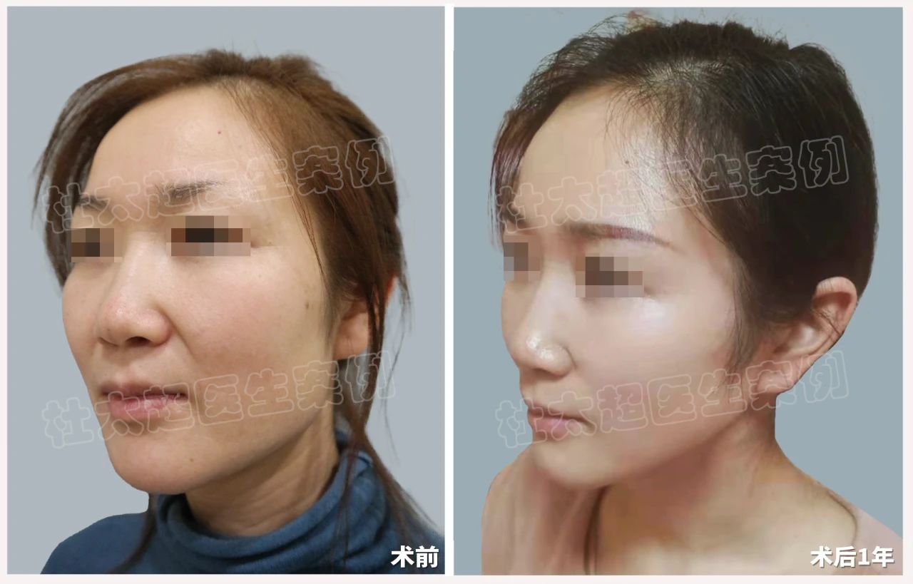 惊呆了！36岁也能拥有20岁的脸？拉皮手术真相何在？