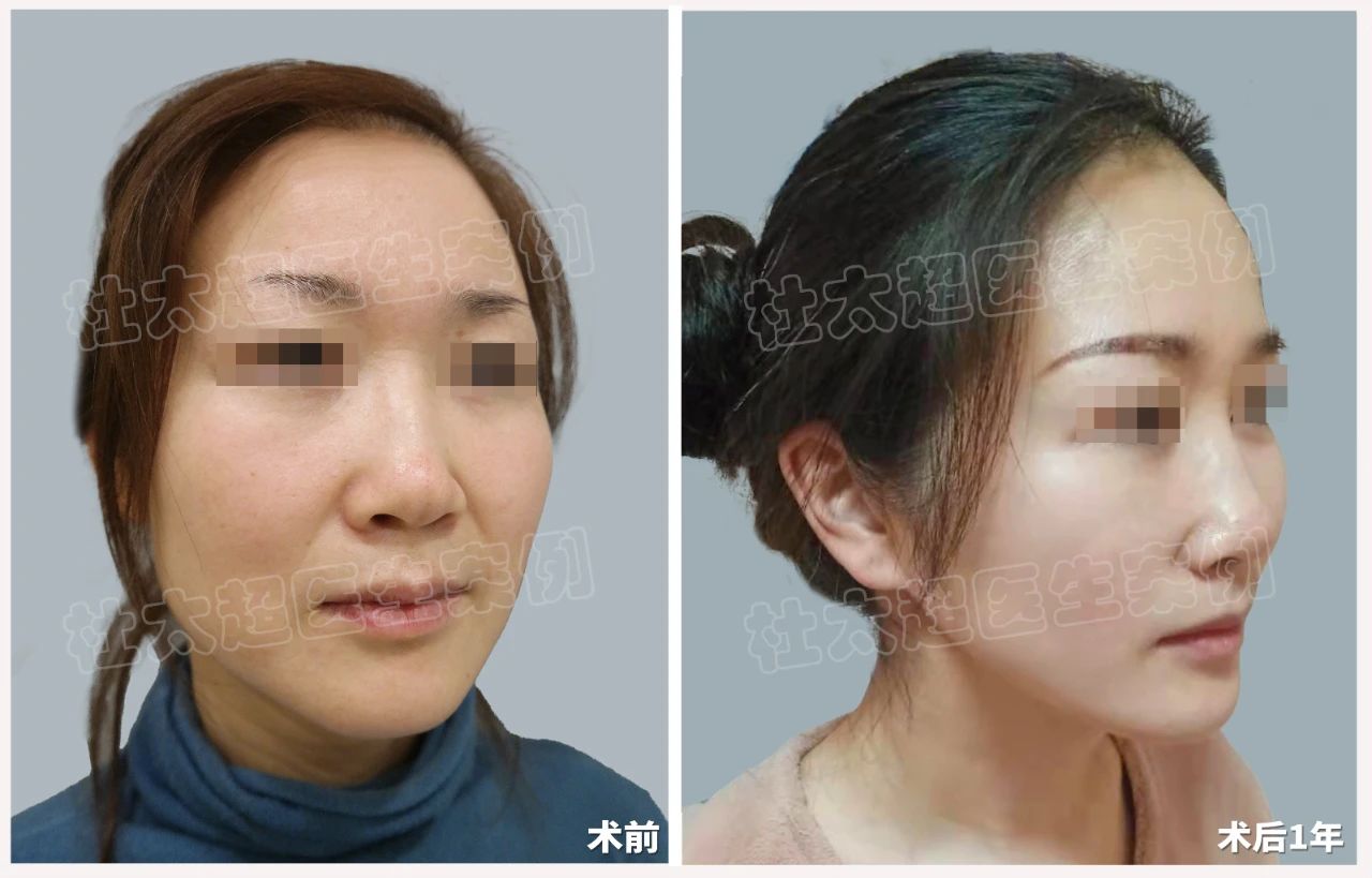 惊呆了！36岁也能拥有20岁的脸？拉皮手术真相何在？