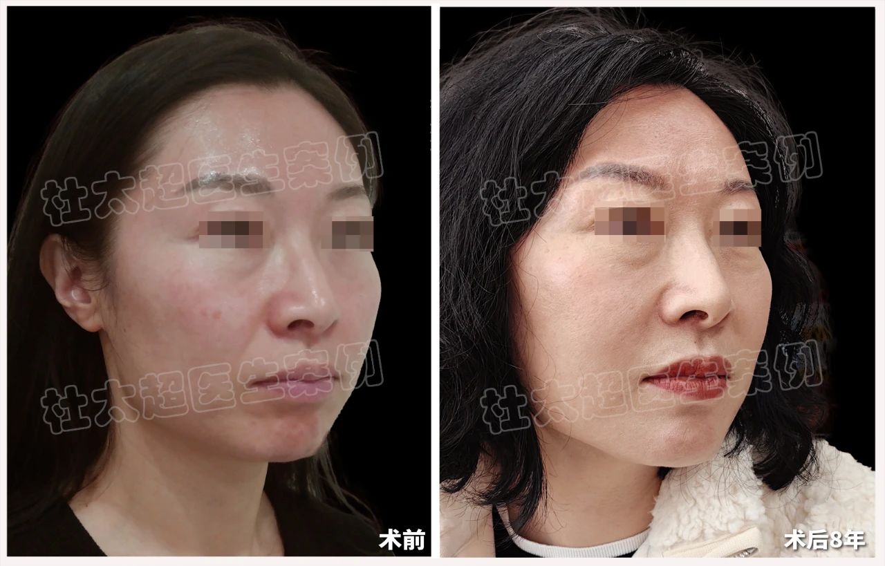 8年前的“泼天富贵”她算是接下了！拉皮手术真的有那么好吗？揭秘‘劲爆’到不行！