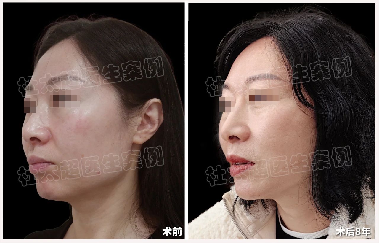 8年前的“泼天富贵”她算是接下了！拉皮手术真的有那么好吗？揭秘‘劲爆’到不行！