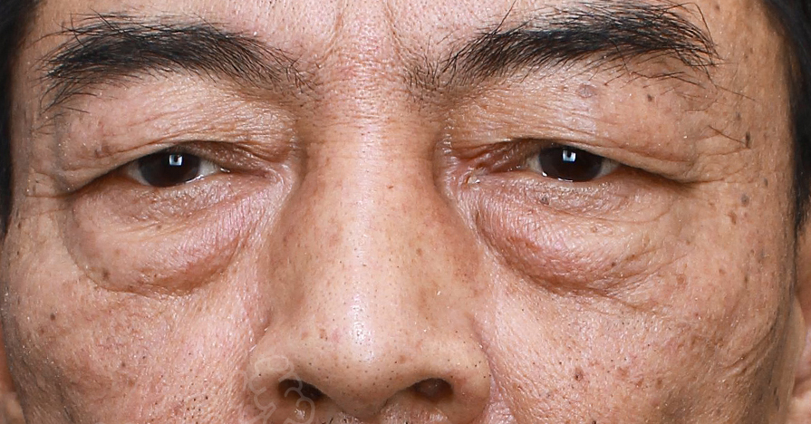 50+男士祛眼袋、提眉过程分享，术后抚平岁月痕迹！