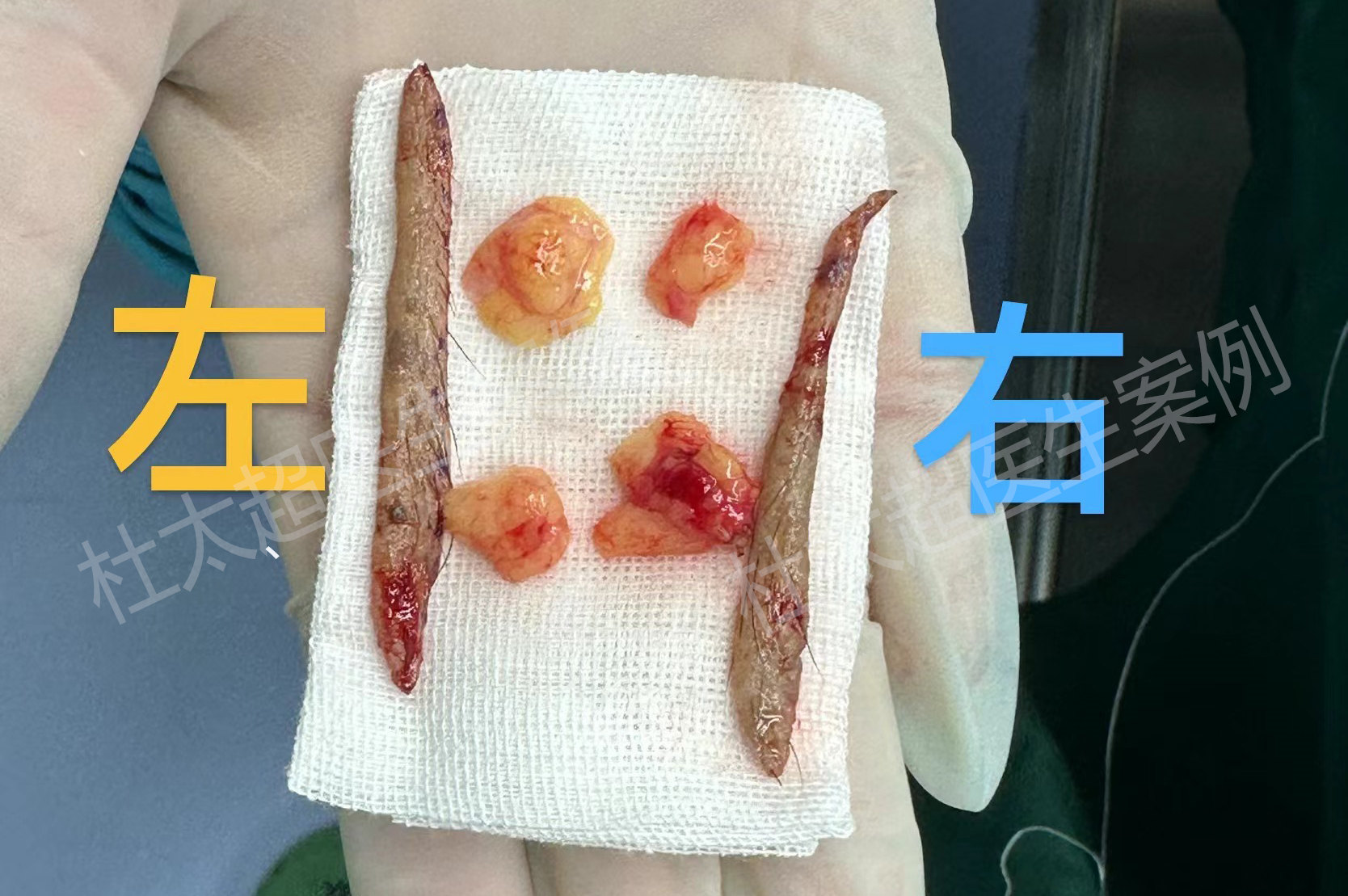 50+男士祛眼袋、提眉过程分享，术后抚平岁月痕迹！