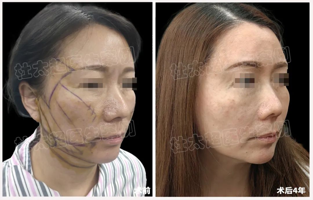 从不屑到惊艳，拉皮手术真有这样神奇？四年后令人刮目相看！