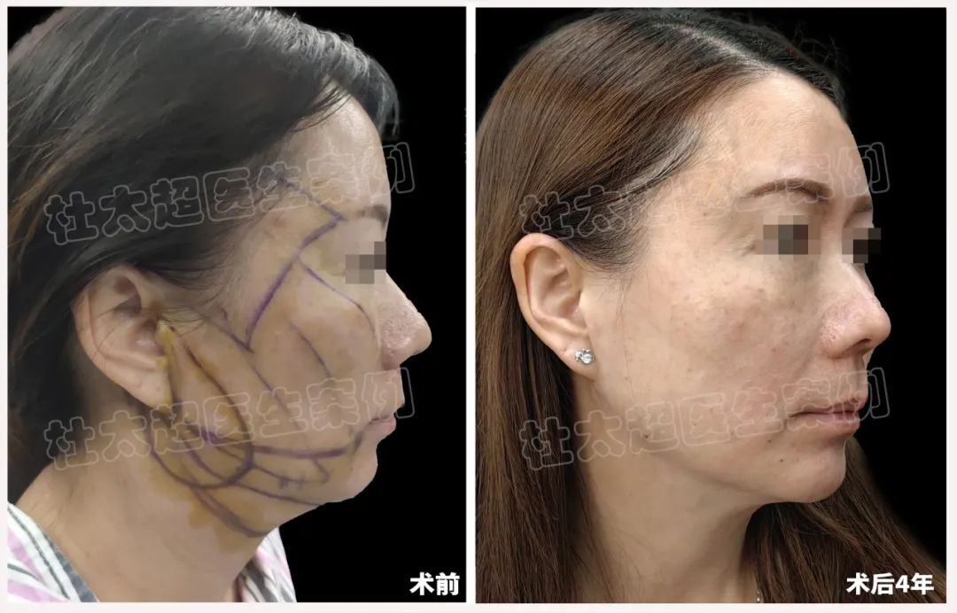 从不屑到惊艳，拉皮手术真有这样神奇？四年后令人刮目相看！