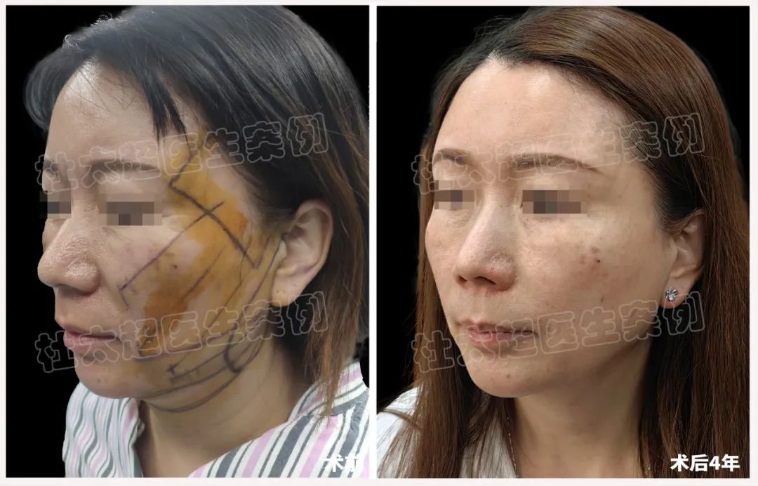 从不屑到惊艳，拉皮手术真有这样神奇？四年后令人刮目相看！