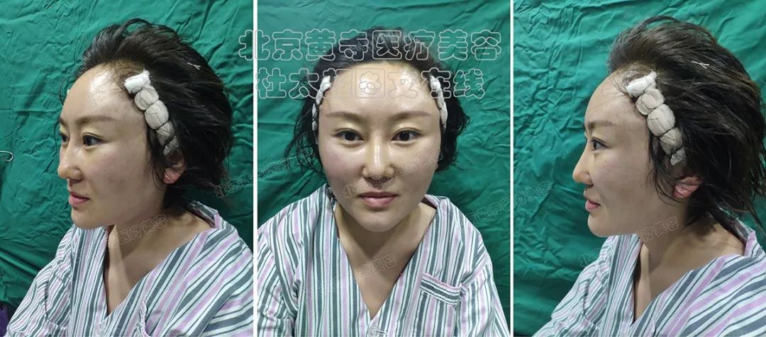 拉皮手术即做即走？小切口大不同！年轻就这么简单！