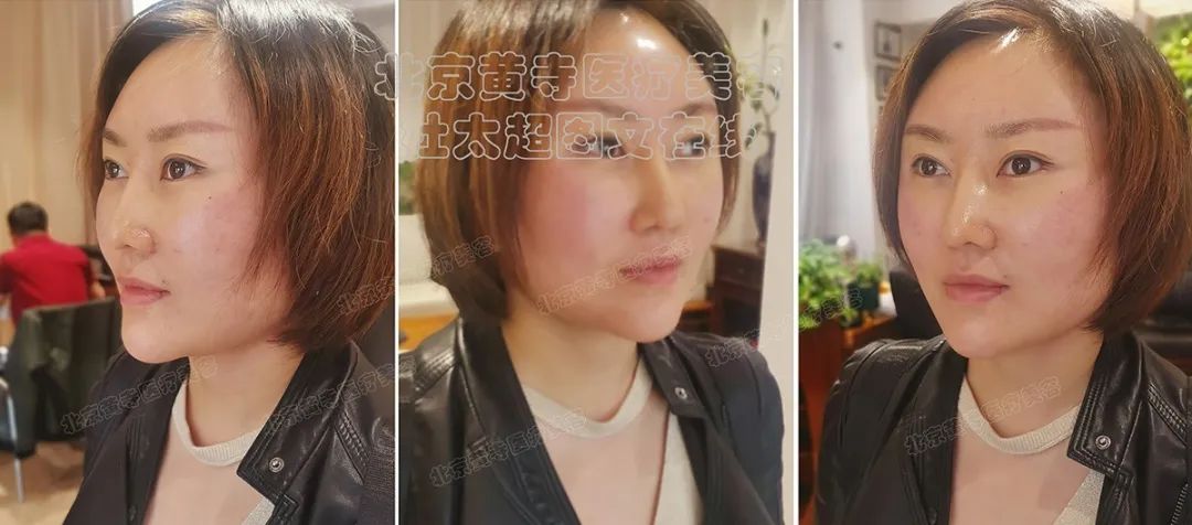 拉皮手术即做即走？小切口大不同！年轻就这么简单！