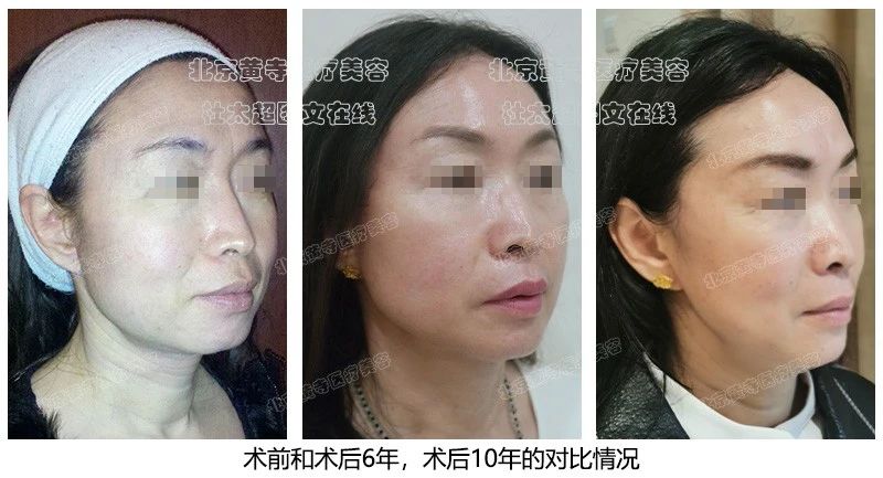 哇塞！时光倒流？惊叹拉皮手术不只是手术，10年不老的美丽秘密大公开！