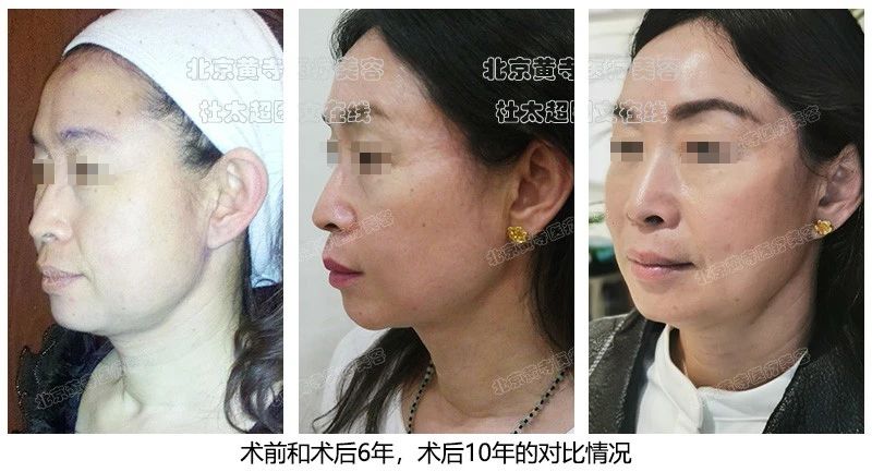 哇塞！时光倒流？惊叹拉皮手术不只是手术，10年不老的美丽秘密大公开！