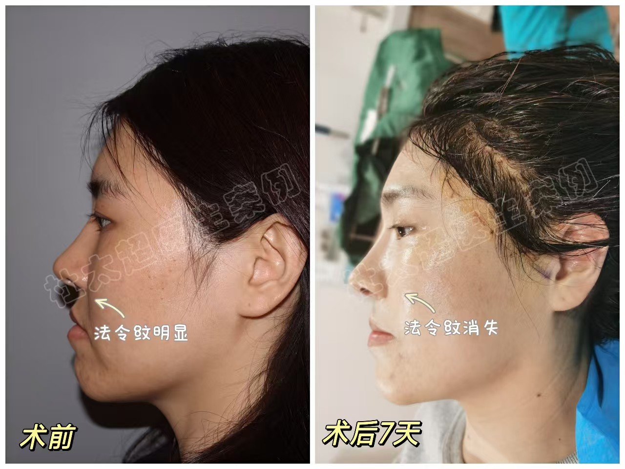 年龄不大想做拉皮手术可以吗？