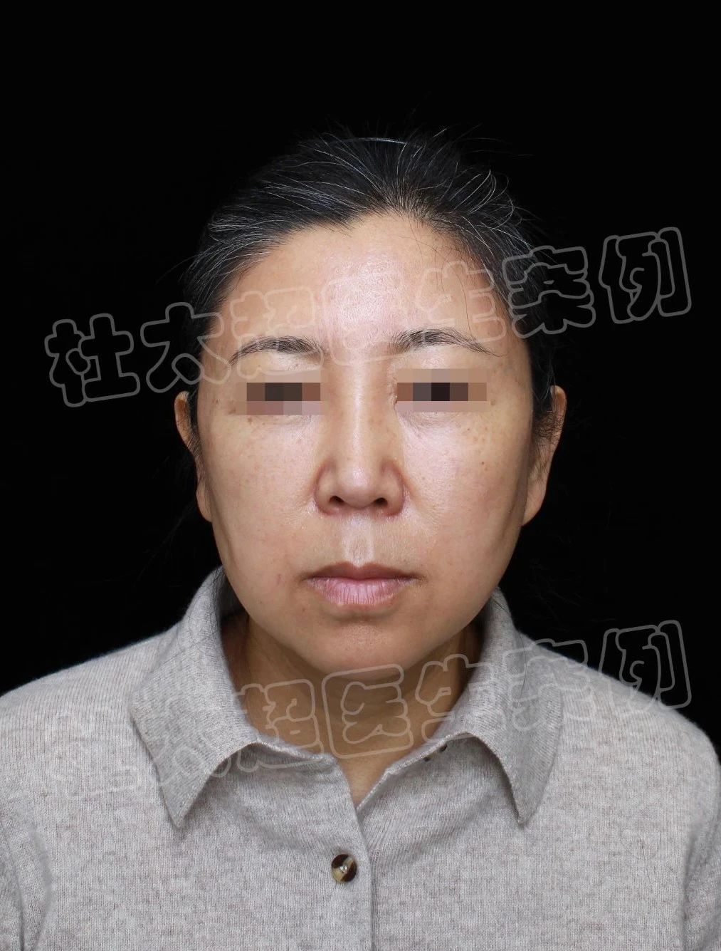 超震惊！50岁大妈拉皮后，秒变20岁少女？大伙直呼“逆天改命”！