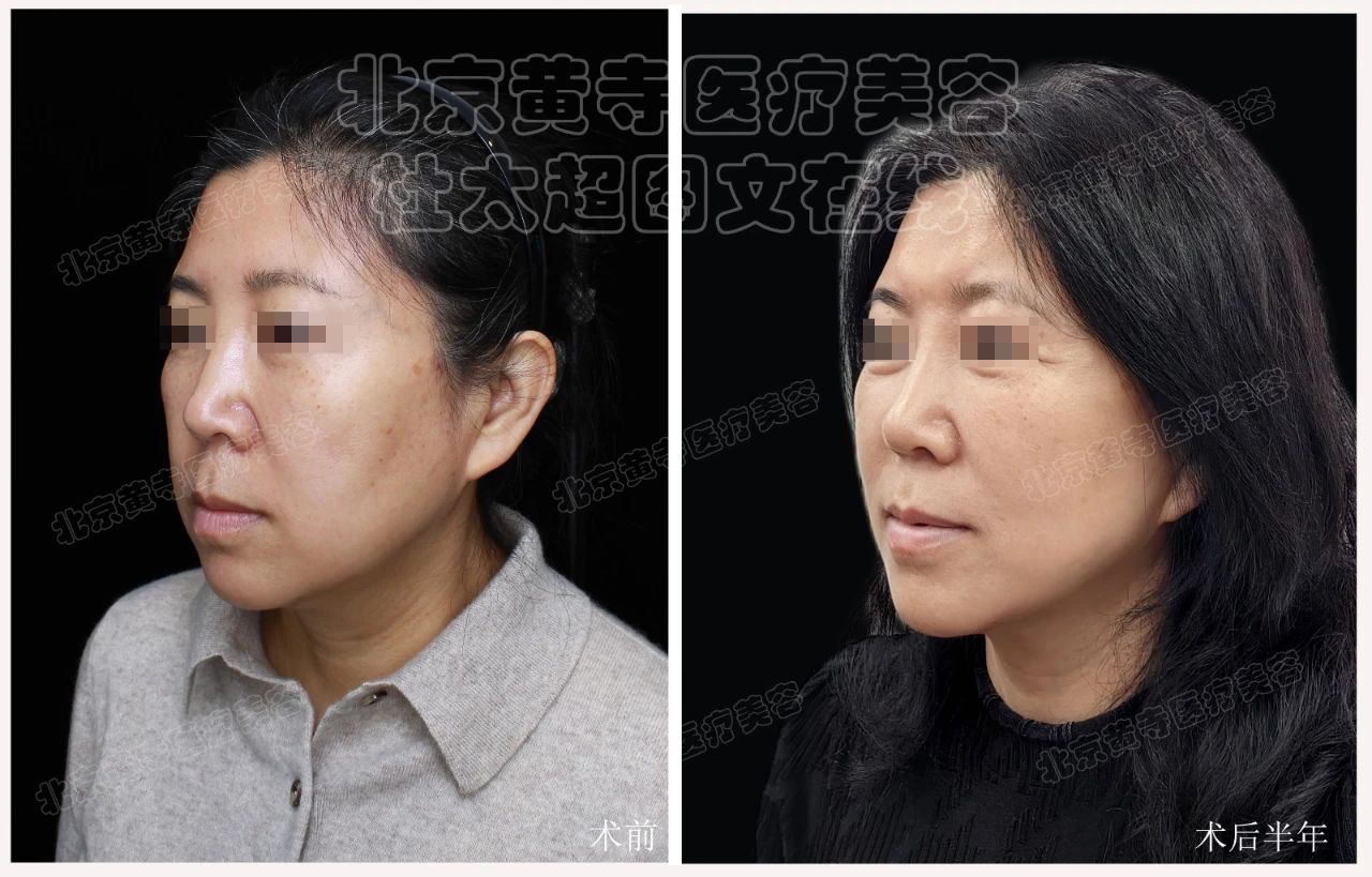 超震惊！50岁大妈拉皮后，秒变20岁少女？大伙直呼“逆天改命”！