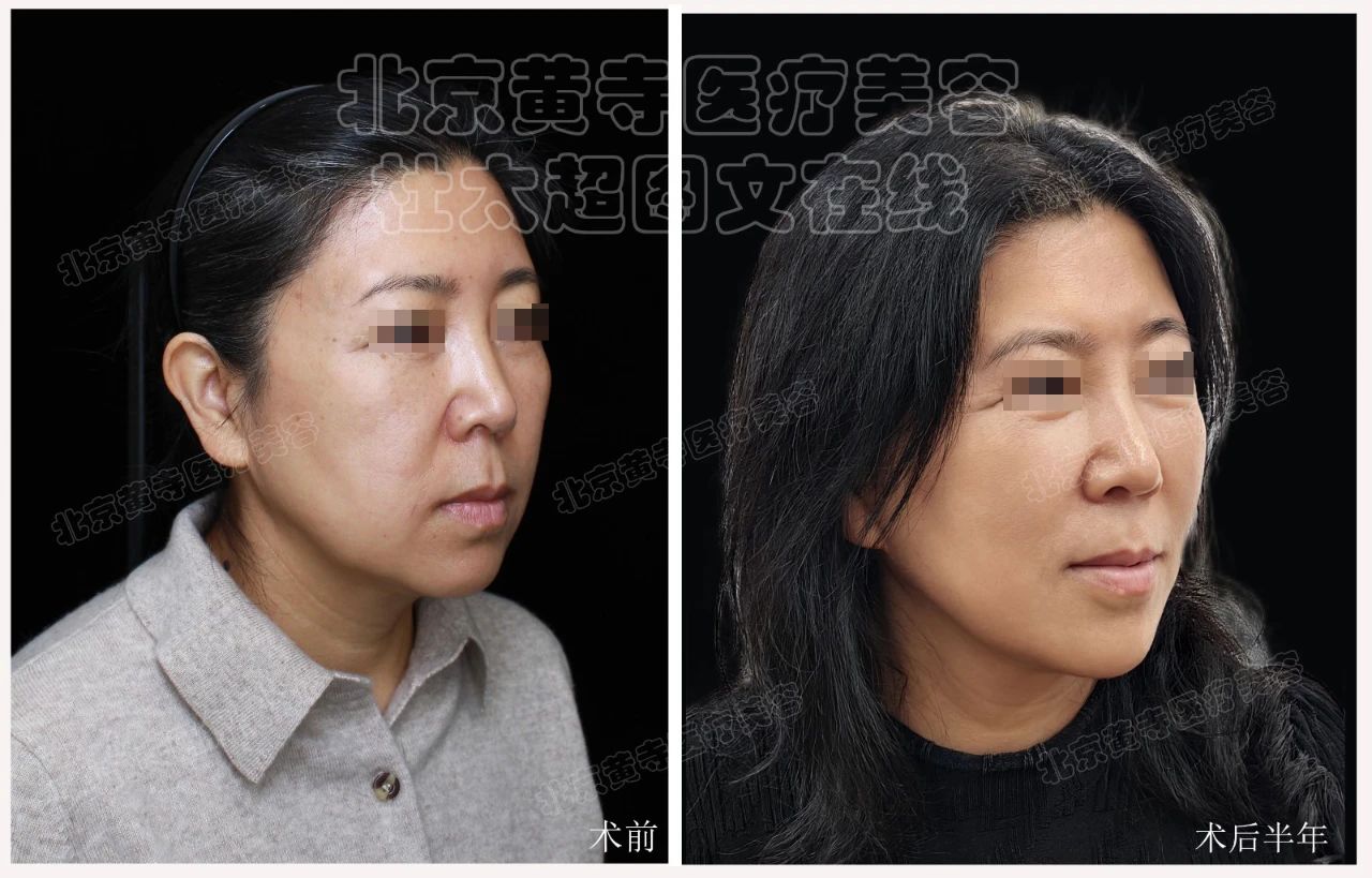 超震惊！50岁大妈拉皮后，秒变20岁少女？大伙直呼“逆天改命”！