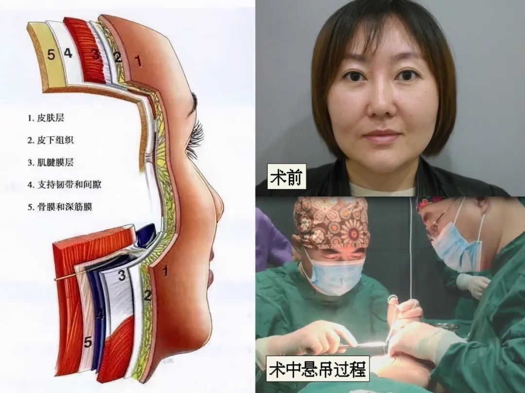 “充气脸”、“馒化脸”不存在的！caw小切口面部提升全过程大曝光！