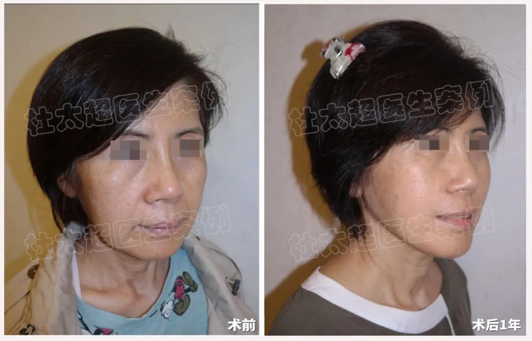 摊牌了！不装了！64岁体验caw小切口面部提升，结果不可思议！