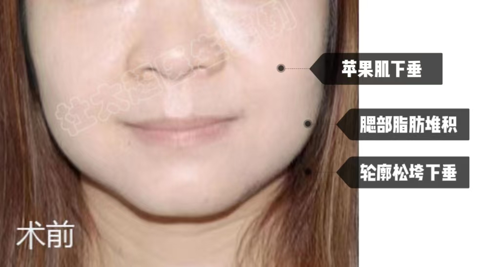 10年前做了拉皮手术的人，现在怎么样了？