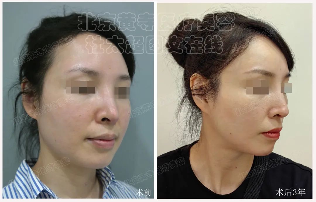 拉皮手术效果这么好？真相揭秘！待看44岁如何保持青春？