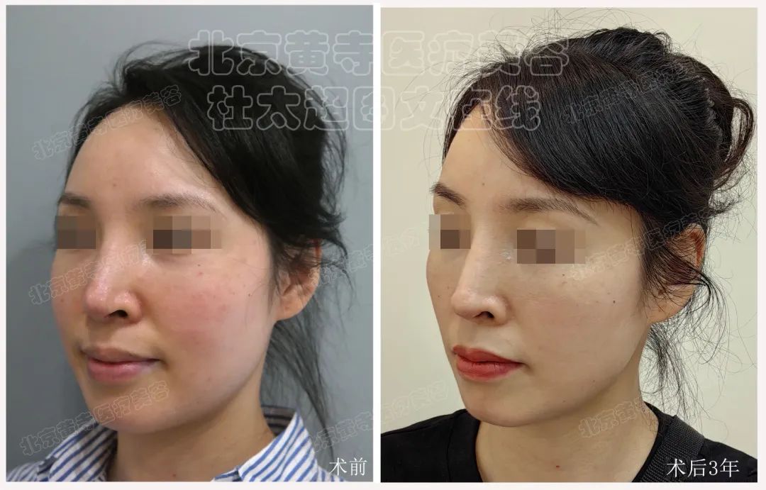 拉皮手术效果这么好？真相揭秘！待看44岁如何保持青春？