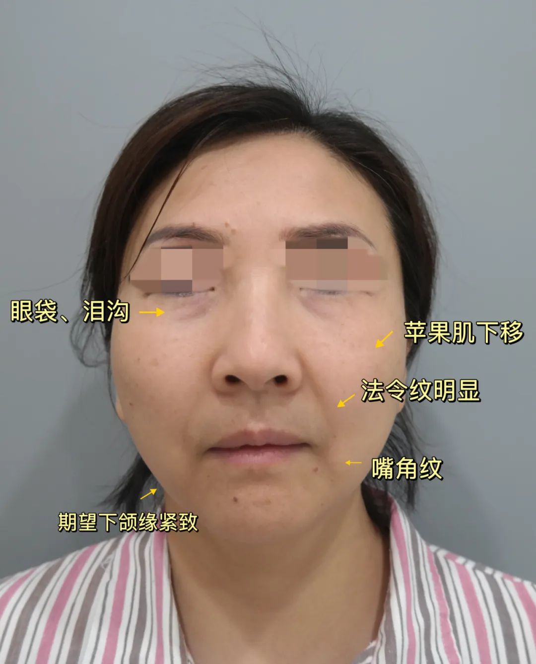 拉皮手术怎么样？医生也疯狂追美？48岁体验拉皮奇迹，效果意想不到！