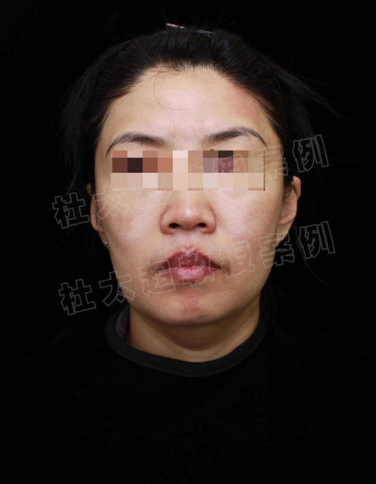 她说太丑！拉皮手术到底给她带来了什么，想要惊艳时光是痴心妄想？