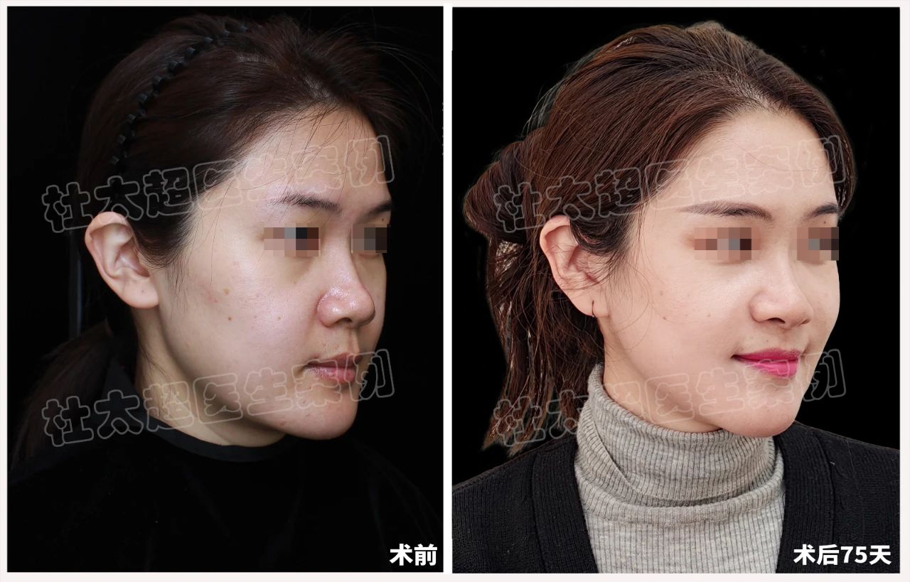 拉皮手术就该悄无声息，告别大刀阔斧的“蜈蚣疤”！