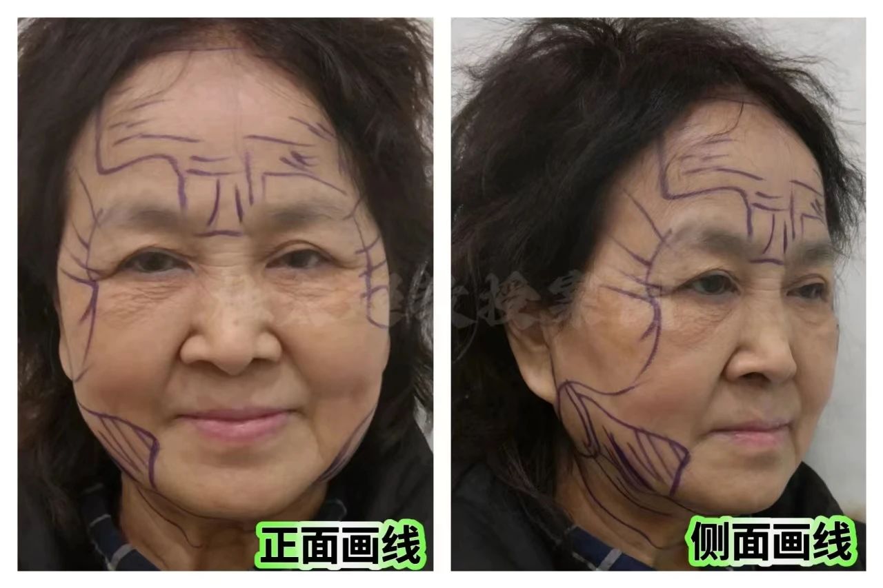 惊呆了！70岁老太太也来抢市场了？拉皮手术后重新定义‘奶奶’一词！