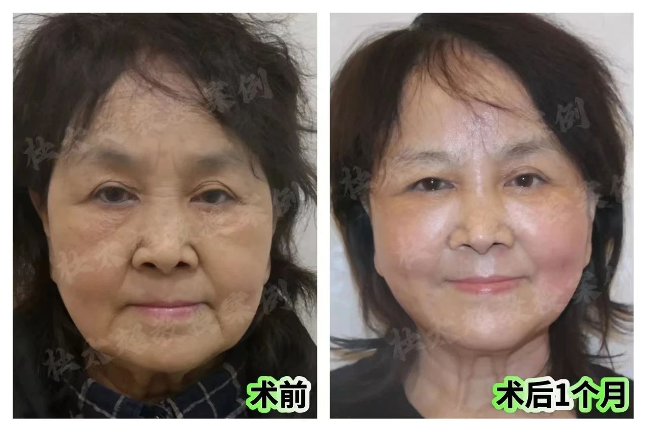 惊呆了！70岁老太太也来抢市场了？拉皮手术后重新定义‘奶奶’一词！