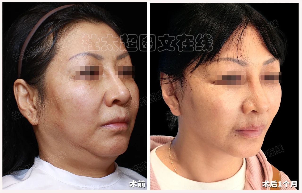 惊！caw小切口面部提升技术竟能让面部‘馒化’瞬间消失？