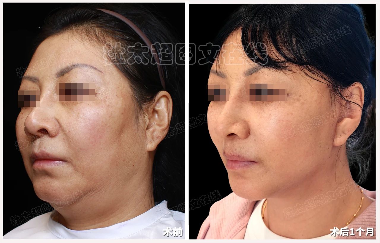 惊！caw小切口面部提升技术竟能让面部‘馒化’瞬间消失？