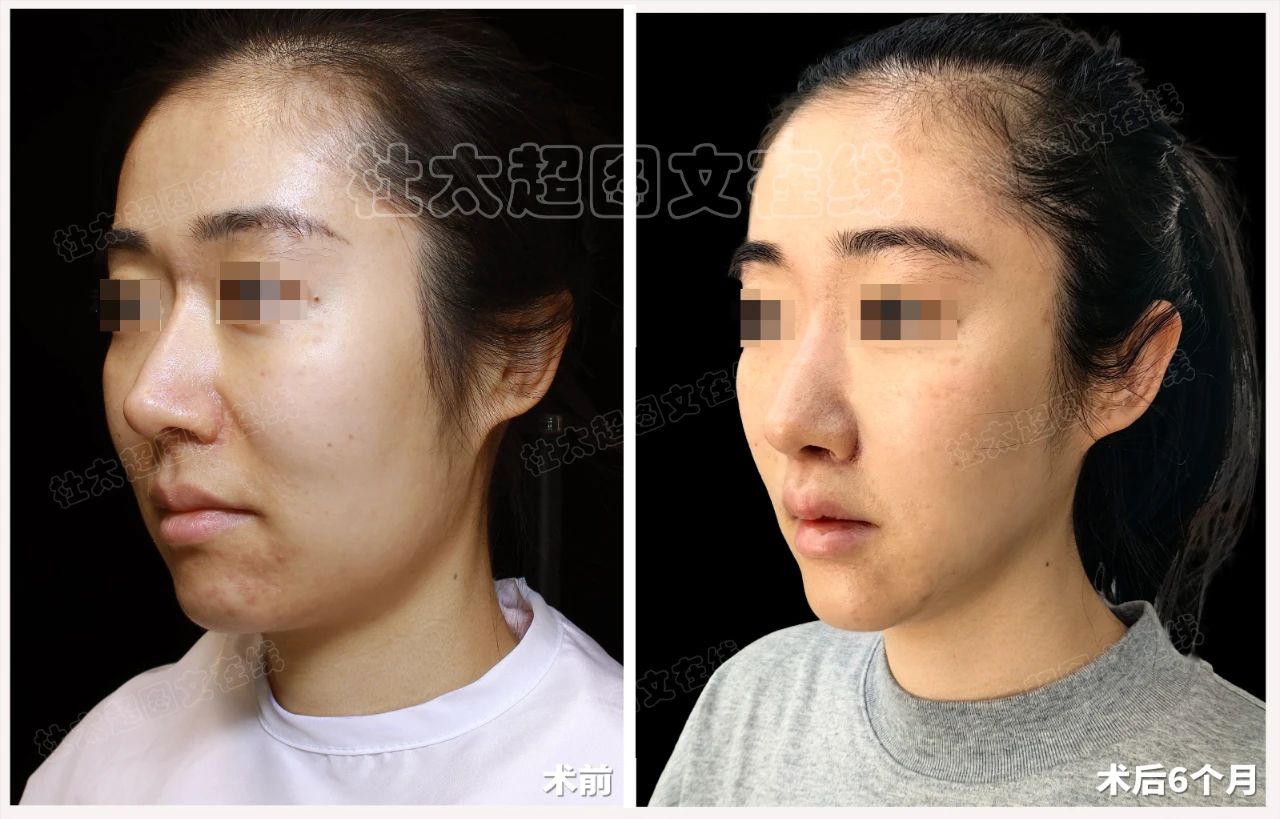 33岁做拉皮手术引发争议？衰老的背后是什么？