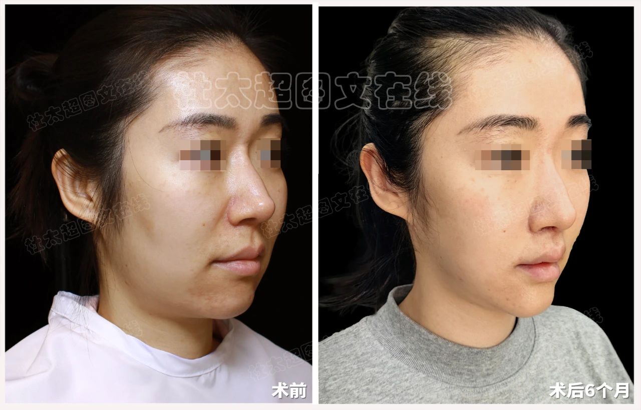 33岁做拉皮手术引发争议？衰老的背后是什么？