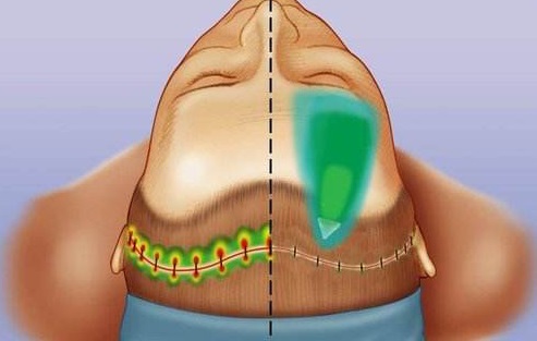 额部除皱和额部拉皮是一回事吗？专业解答来了